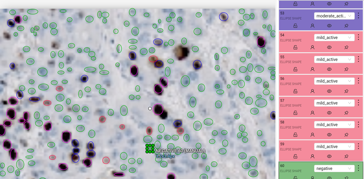 Ki-67 Cell Detection - Annotated Pathology Slide